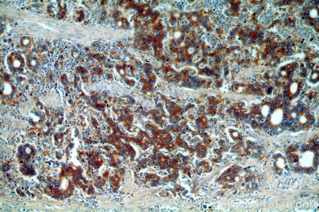 IHC staining of human stomach cancer using 20107-1-AP