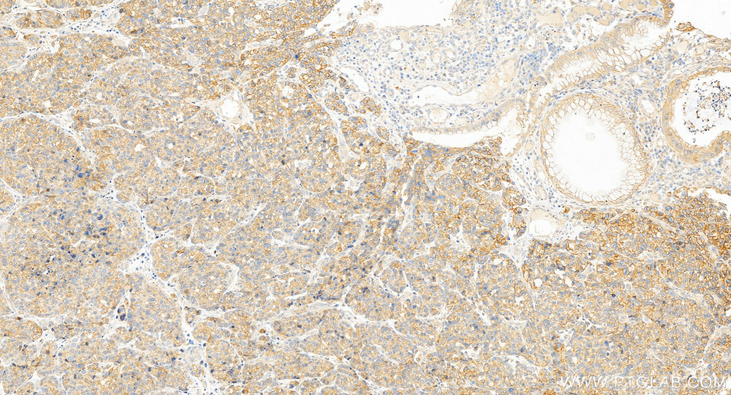 IHC staining of human stomach cancer using 24310-1-AP IHC staining of human stomach cancer using 24310-1-AP