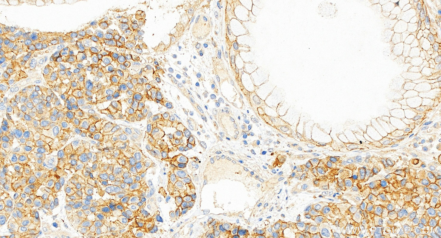 IHC staining of human stomach cancer using 24310-1-AP IHC staining of human stomach cancer using 24310-1-AP