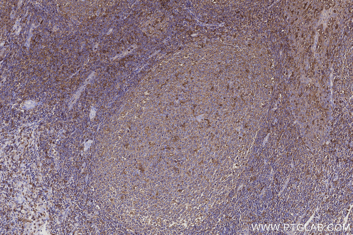 IHC staining of human tonsillitis using 83264-5-RR IHC staining of human tonsillitis using 83264-5-RR