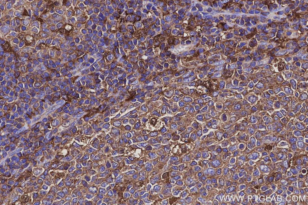 IHC staining of human tonsillitis using 83264-5-RR IHC staining of human tonsillitis using 83264-5-RR
