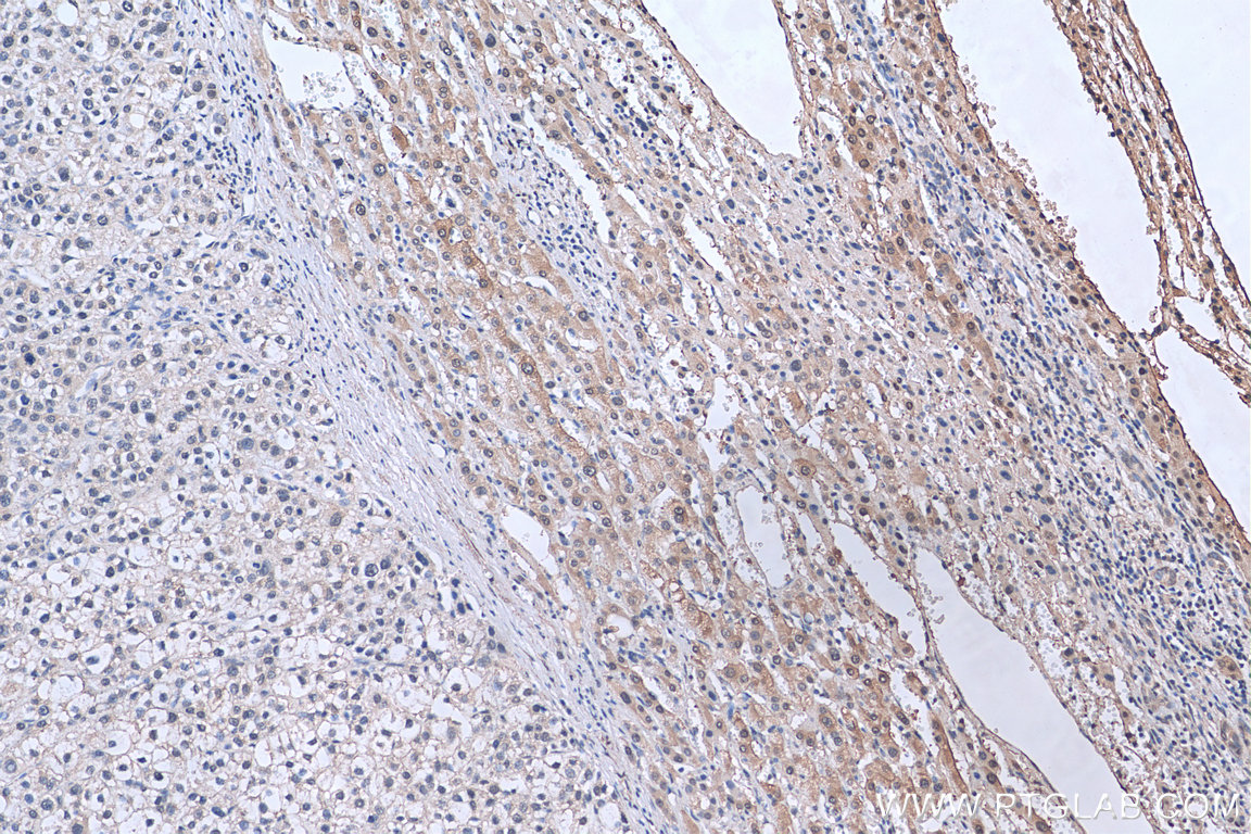 IHC staining of human liver cancer using 67855-1-Ig (same clone as 67855-1-PBS)