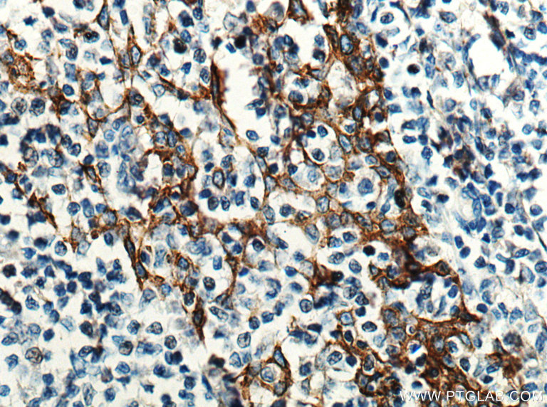 IHC staining of human tonsillitis using 66455-1-Ig (same clone as 66455-1-PBS)
