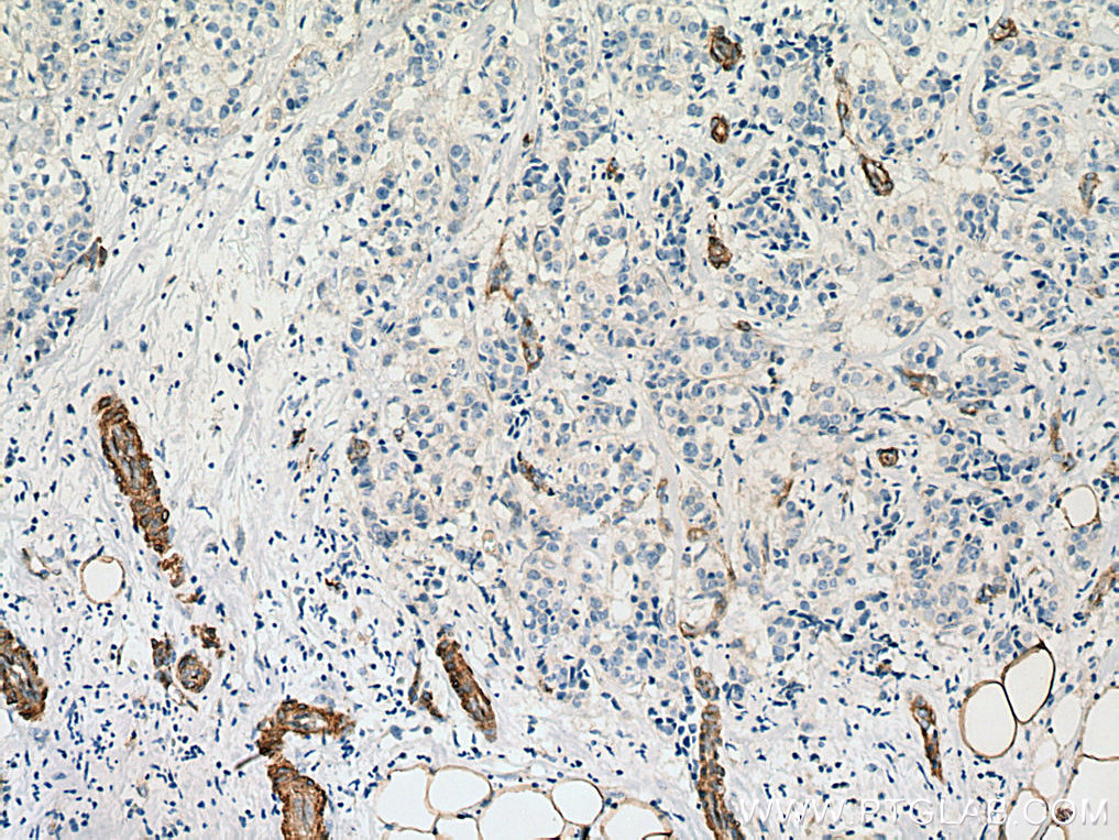 IHC staining of human breast cancer using 11440-1-AP