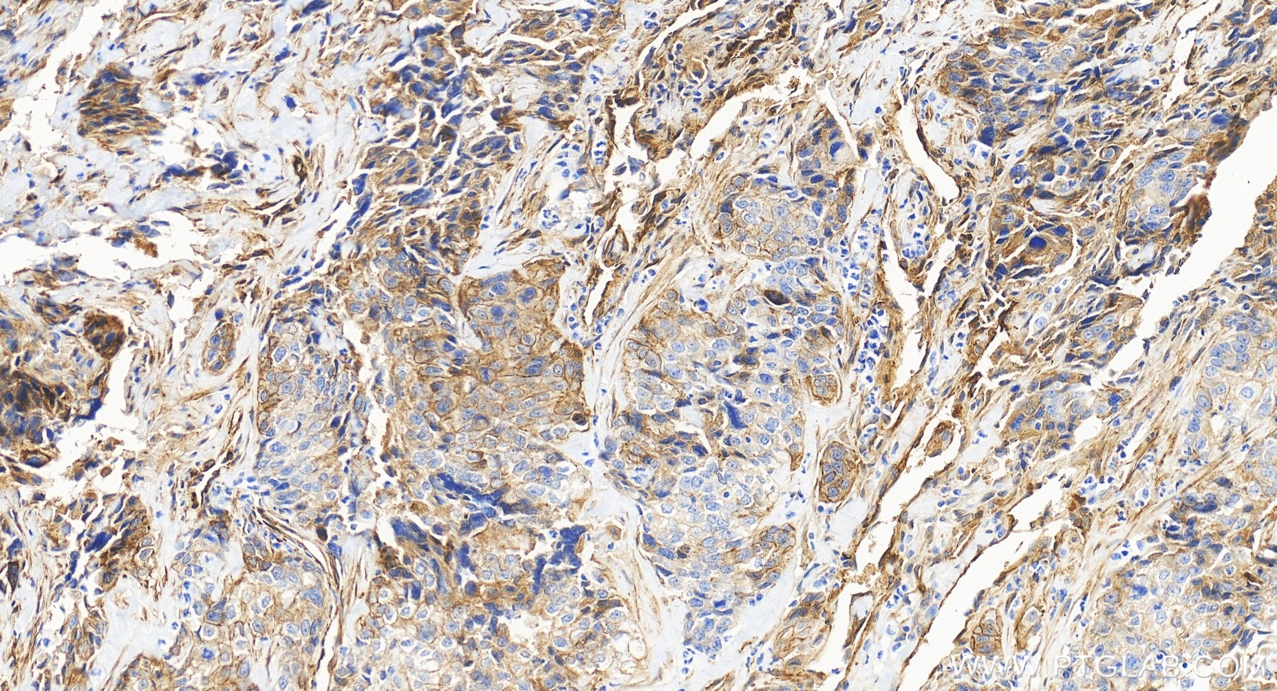 IHC staining of human ovary cancer using 85604-4-RR