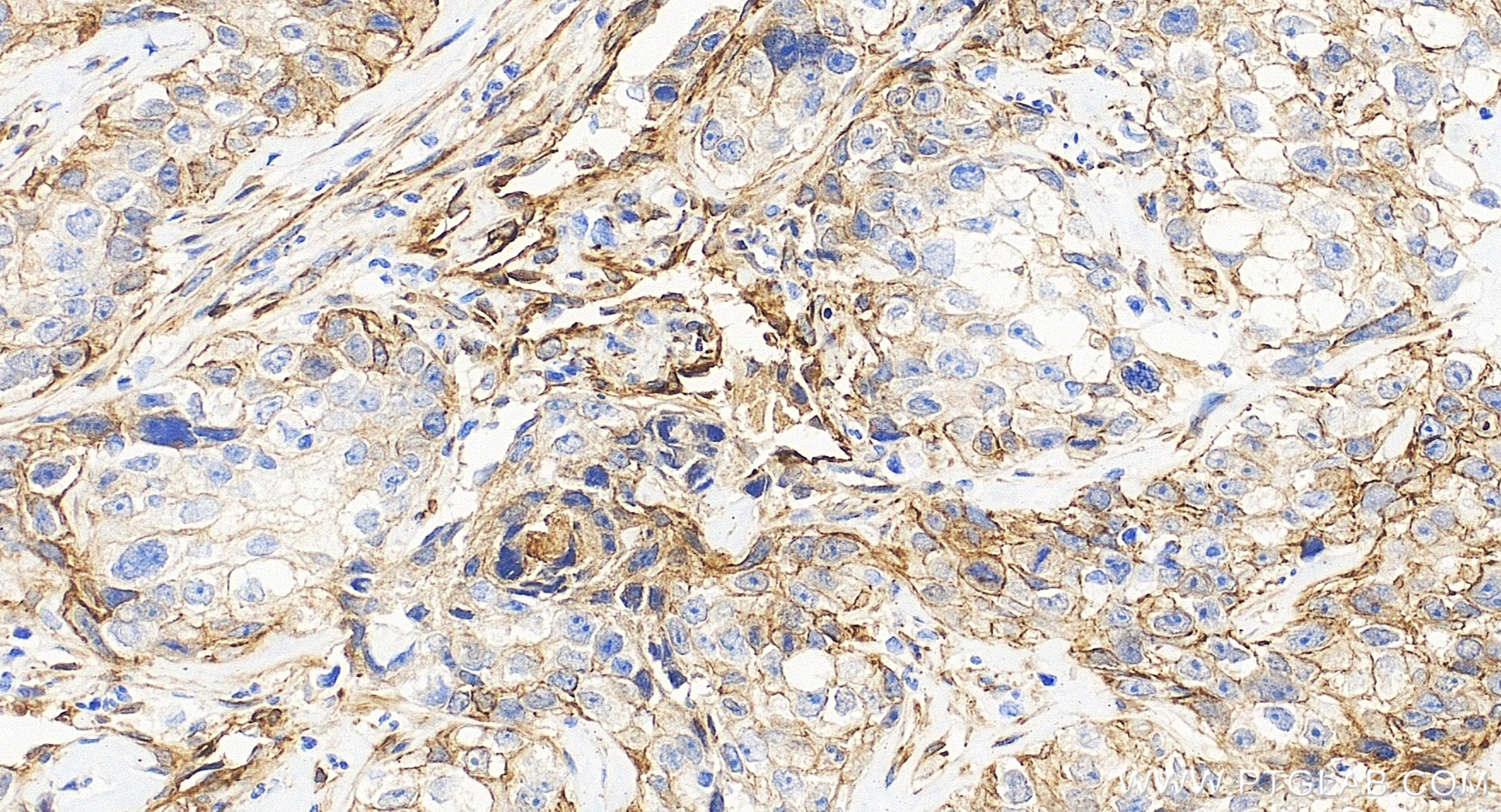 IHC staining of human ovary cancer using 85604-4-RR