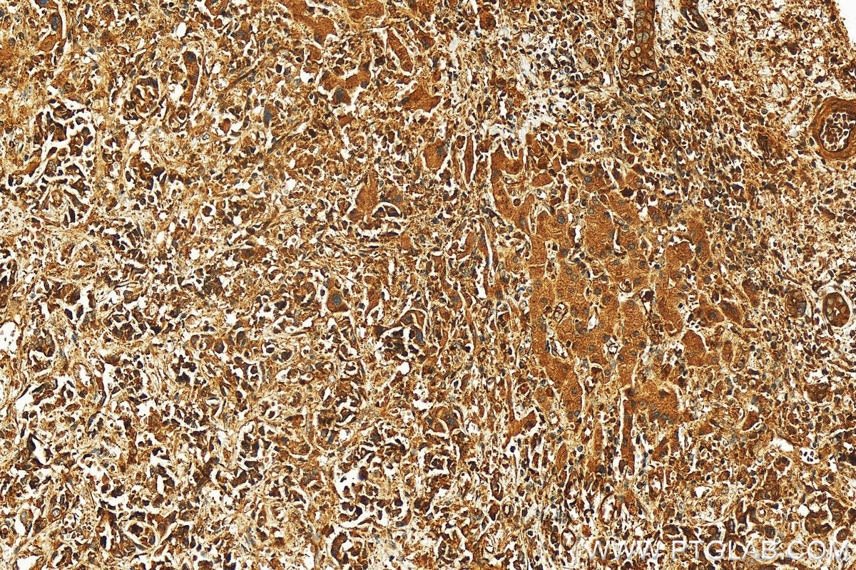 IHC staining of human intrahepatic cholangiocarcinoma using 11382-2-AP