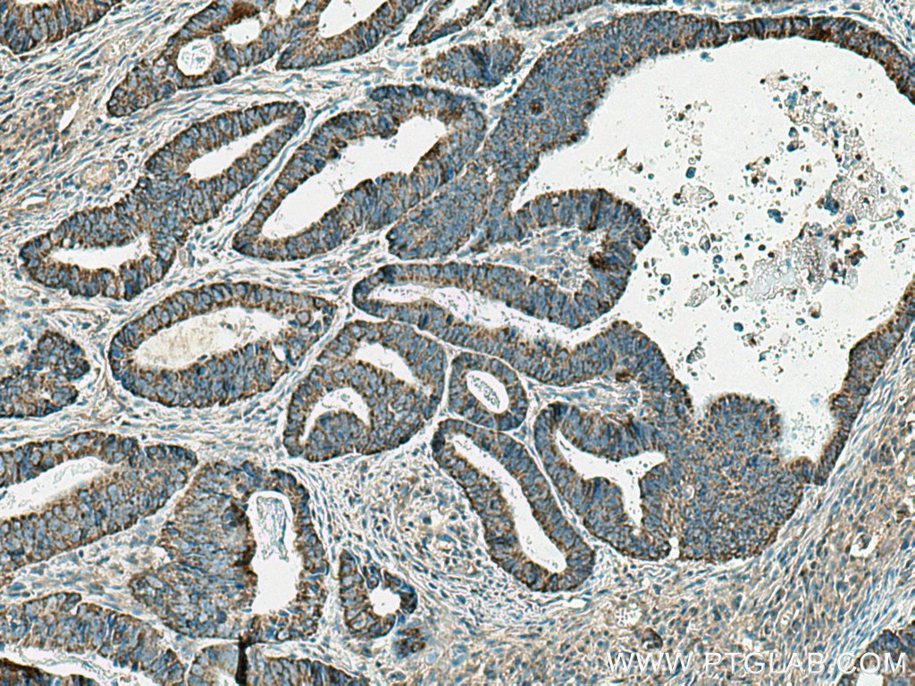 IHC staining of human colon cancer using 20456-1-AP