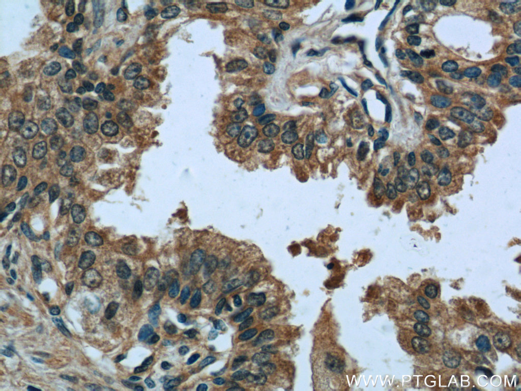 IHC staining of human prostate cancer using 15276-1-AP