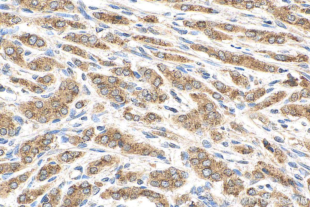 IHC staining of human prostate cancer using 11233-1-AP