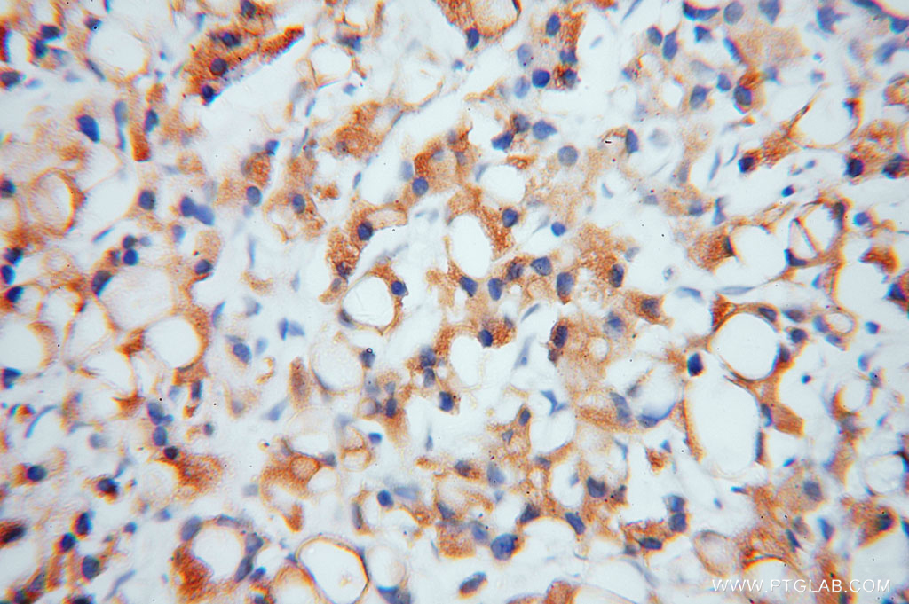 IHC staining of human prostate cancer using 11233-1-AP