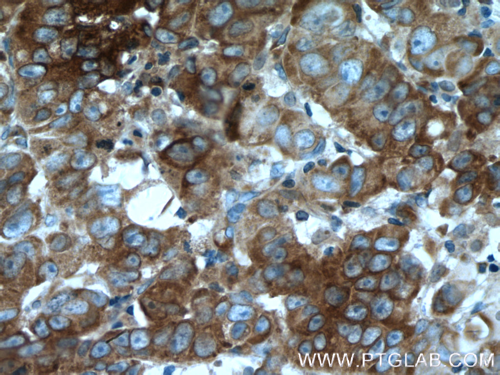IHC staining of human prostate cancer using 66482-1-Ig (same clone as 66482-1-PBS)