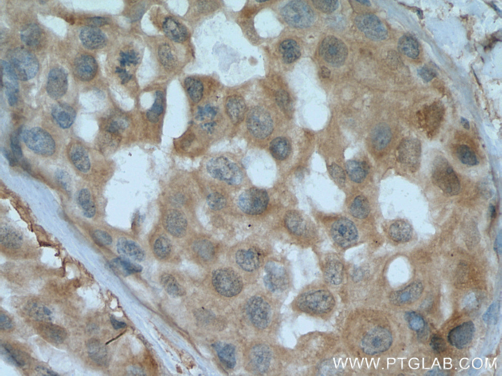 IHC staining of human breast cancer using 20499-1-AP