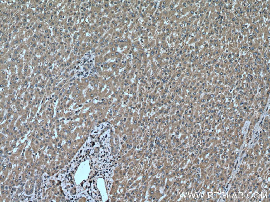 IHC staining of human liver cancer using 24390-1-AP