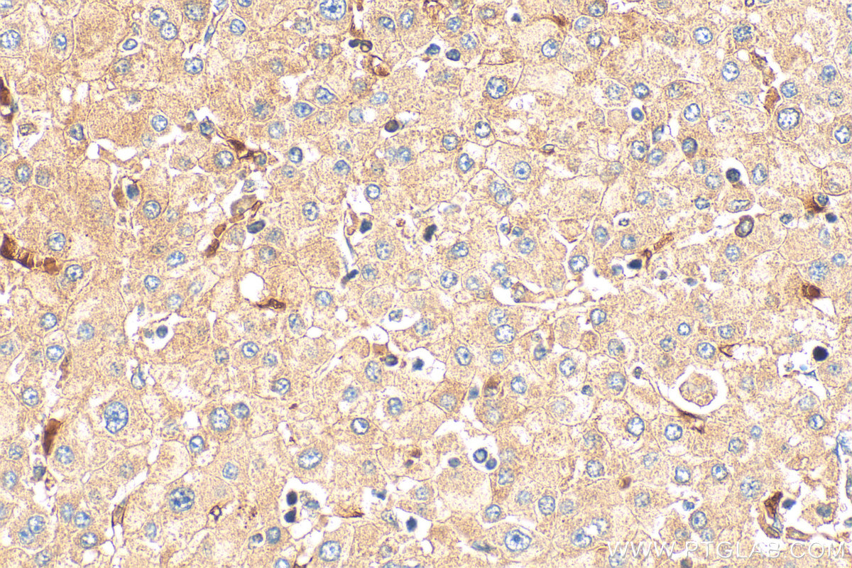 IHC staining of human liver cancer using 24390-1-AP