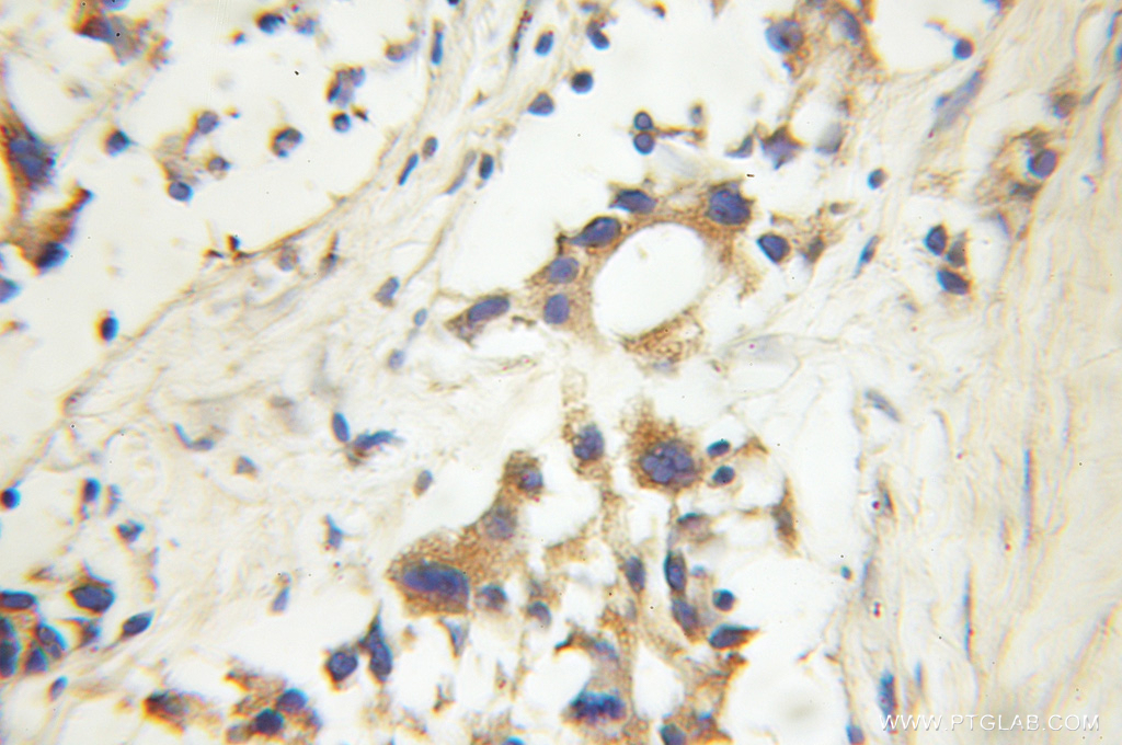 IHC staining of human prostate cancer using 11174-1-AP