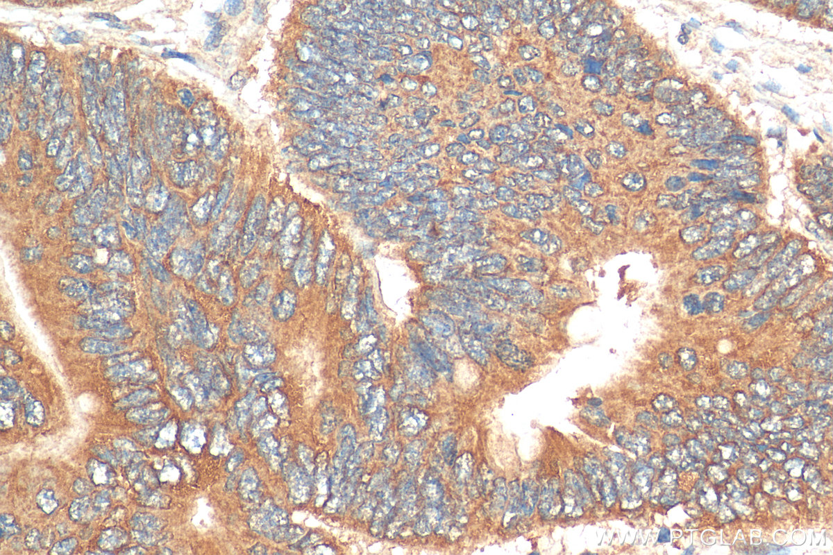 IHC staining of human colon cancer using 29935-1-AP
