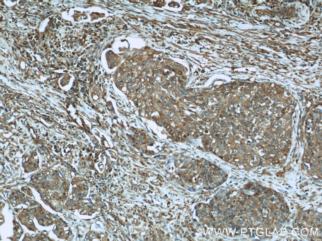 IHC staining of human cervical cancer using 19690-1-AP (same clone as 19690-1-PBS)