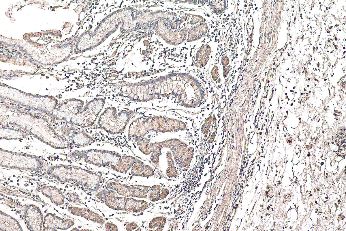 IHC staining of human stomach cancer using 19692-1-AP (same clone as 19692-1-PBS)