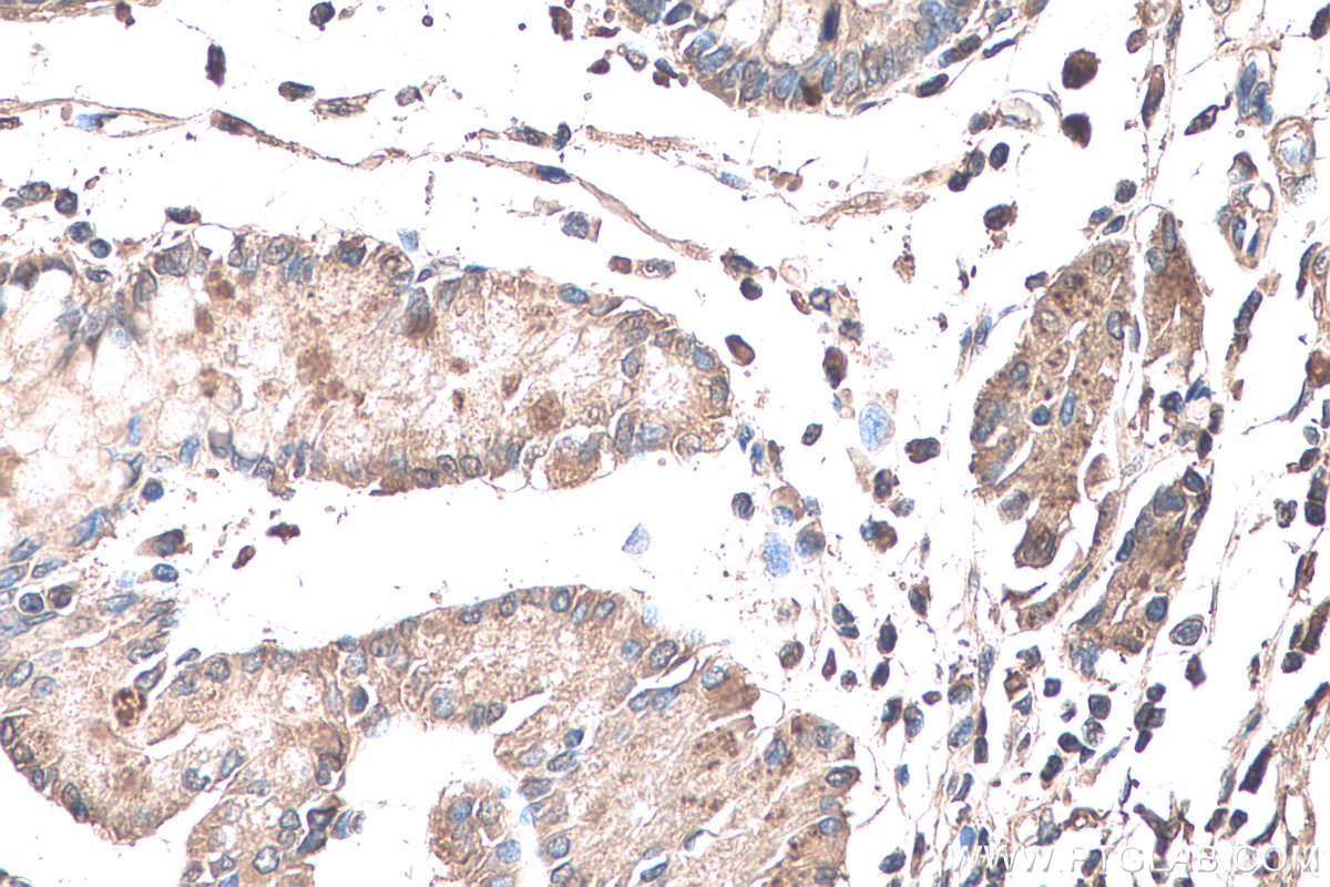 IHC staining of human stomach cancer using 19692-1-AP (same clone as 19692-1-PBS)