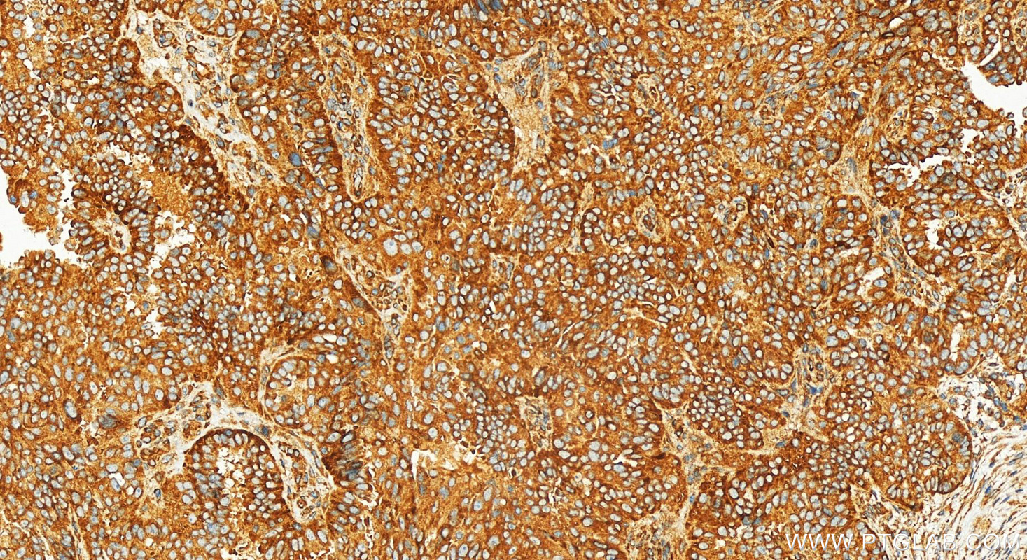 IHC staining of human ovarian  cancer using 82936-8-RR