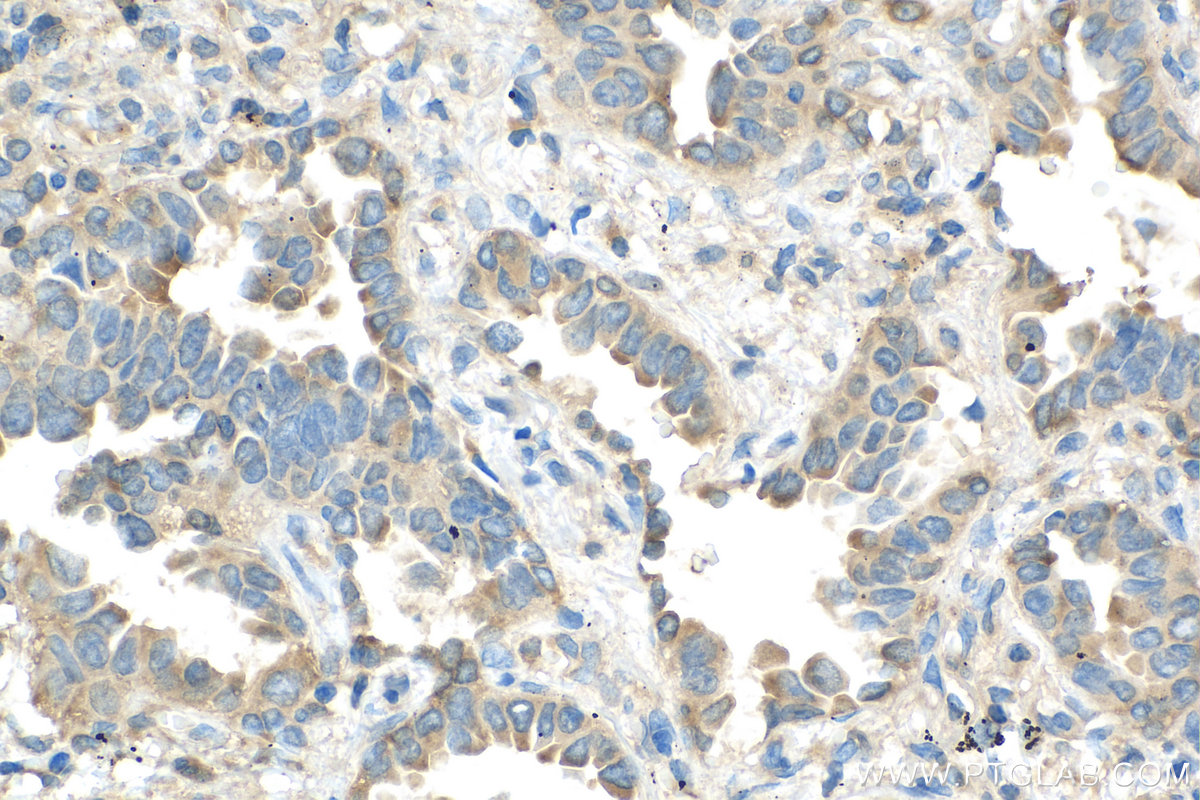 IHC staining of human lung cancer using 27665-1-AP