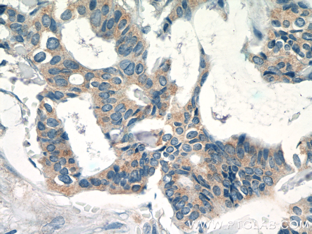 IHC staining of human breast cancer using 10219-1-AP