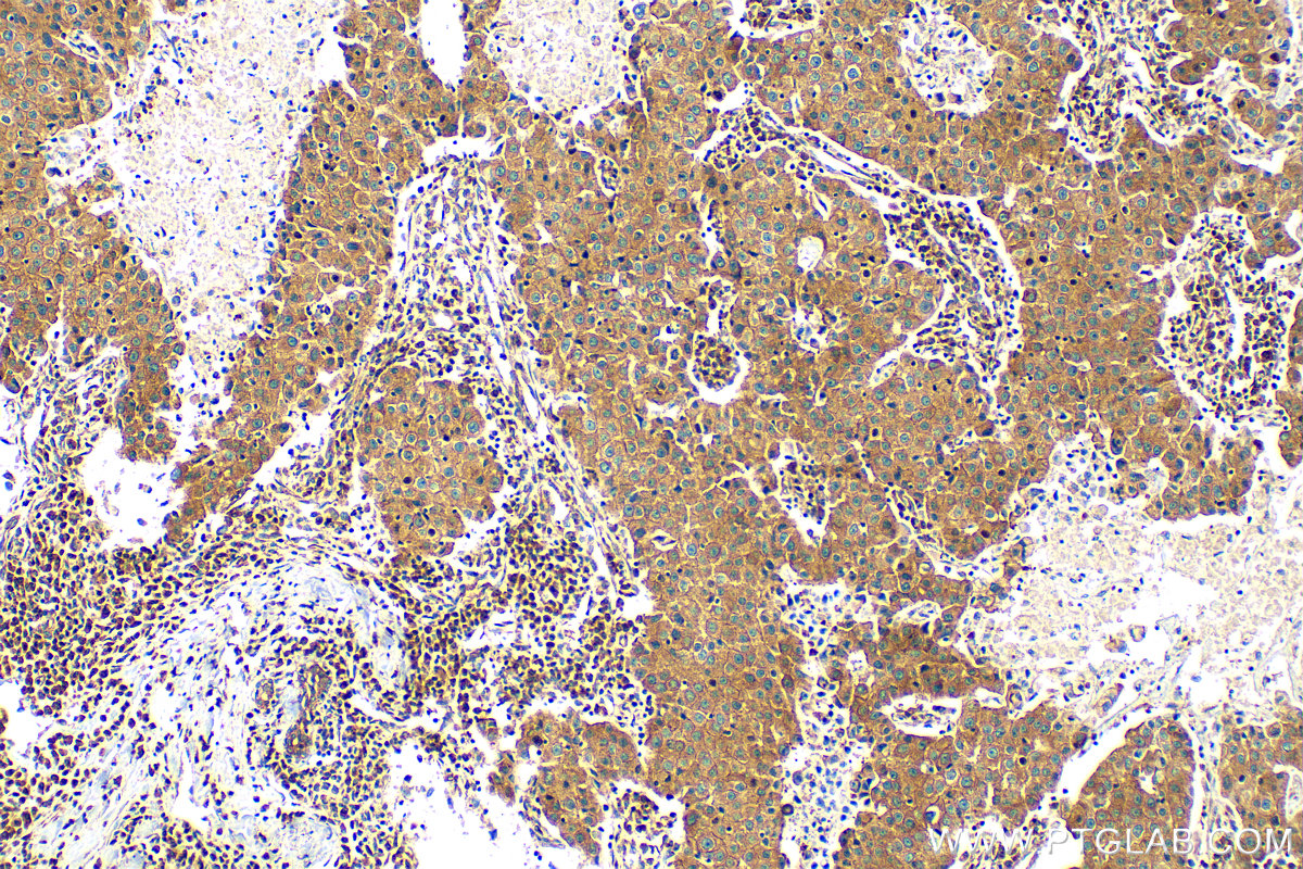 IHC staining of human breast cancer using 82512-1-RR (same clone as 82512-1-PBS)