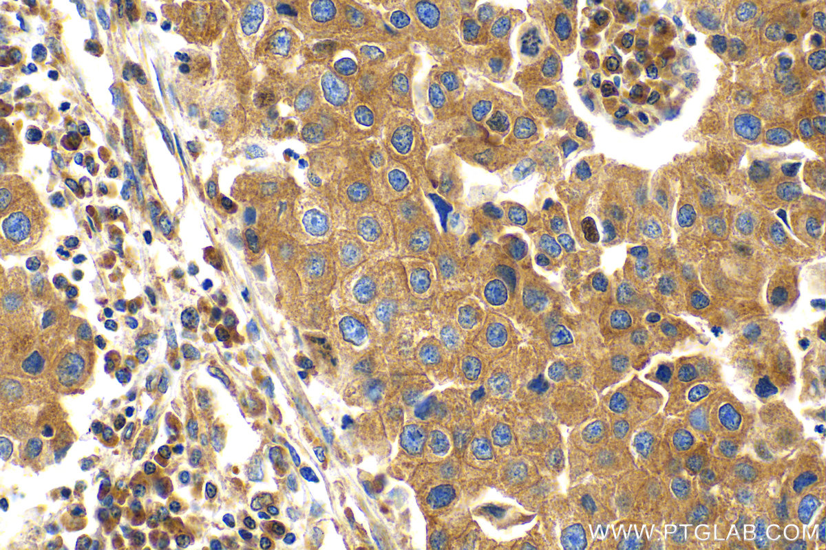 IHC staining of human breast cancer using 82512-1-RR (same clone as 82512-1-PBS)