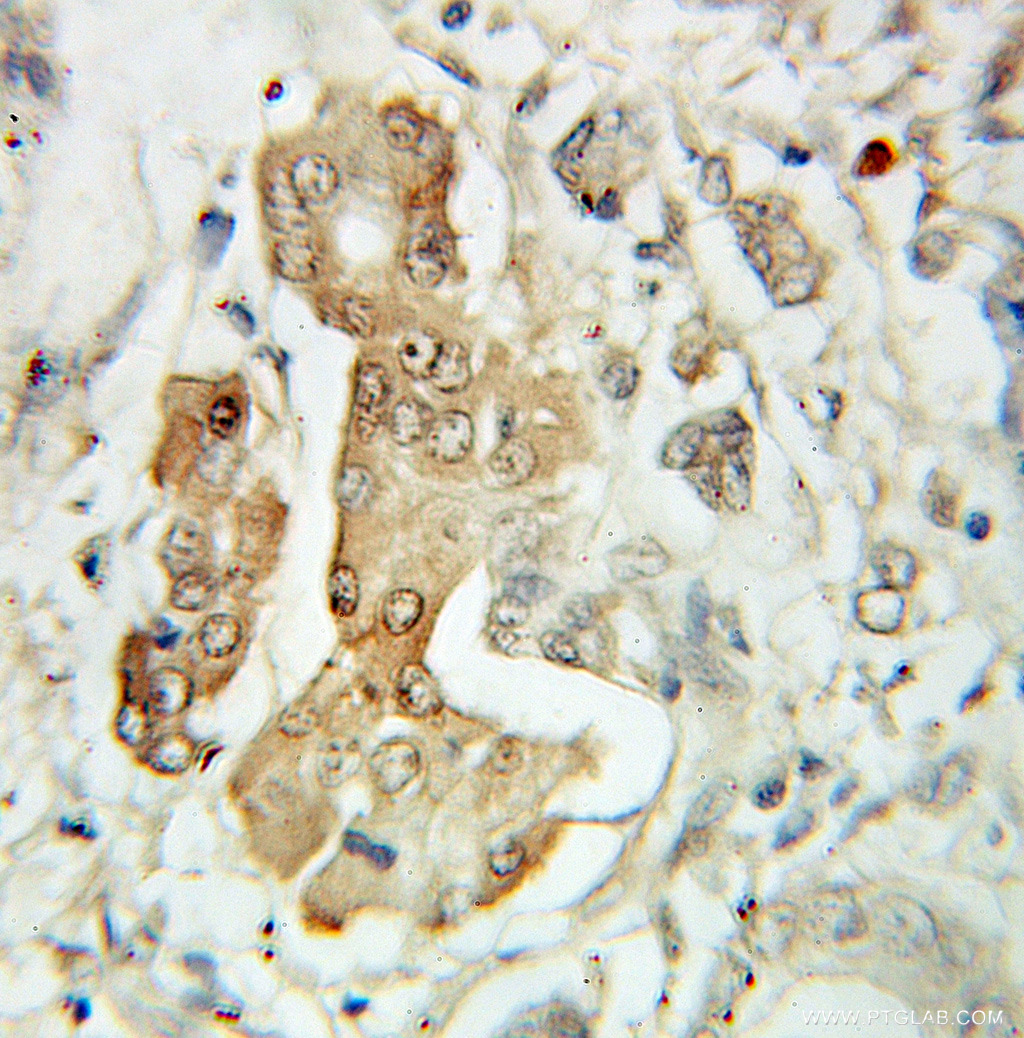 IHC staining of human pancreas cancer using 10899-1-AP