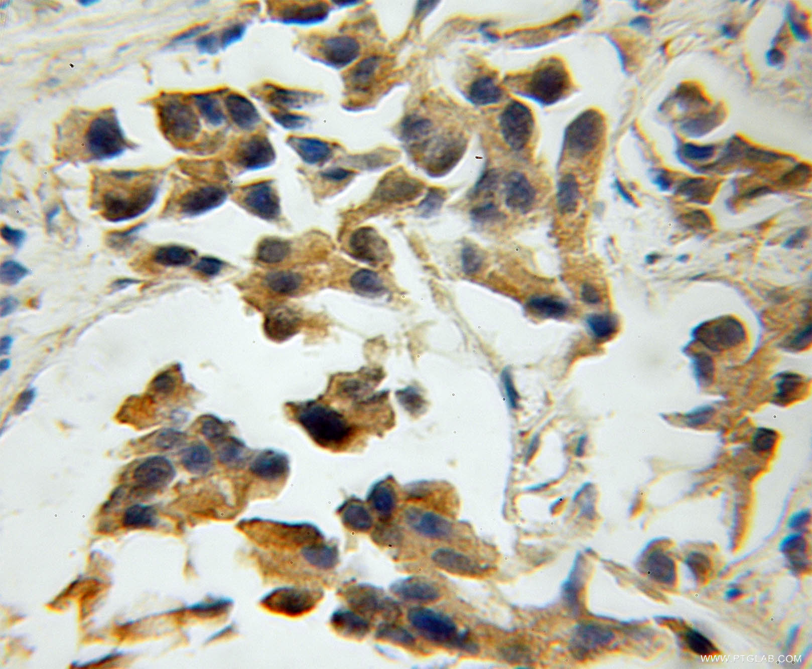 IHC staining of human prostate cancer using 11165-1-AP