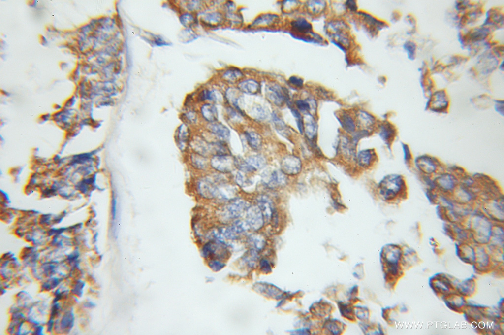 IHC staining of human breast cancer using 10439-1-AP