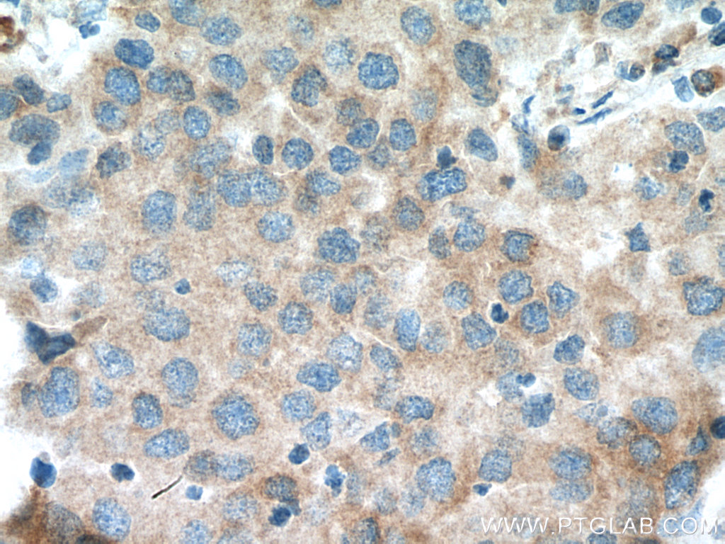 IHC staining of human breast cancer using 11280-1-AP