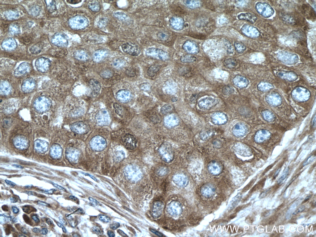 IHC staining of human breast cancer using 15704-1-AP