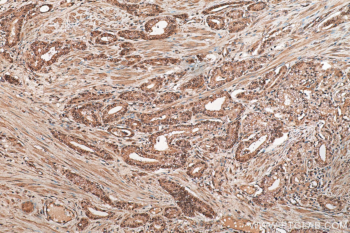 IHC staining of human prostate cancer using 17069-1-AP