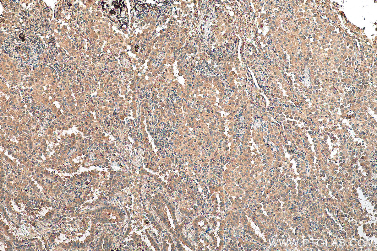 IHC staining of human lung cancer using 67907-1-Ig