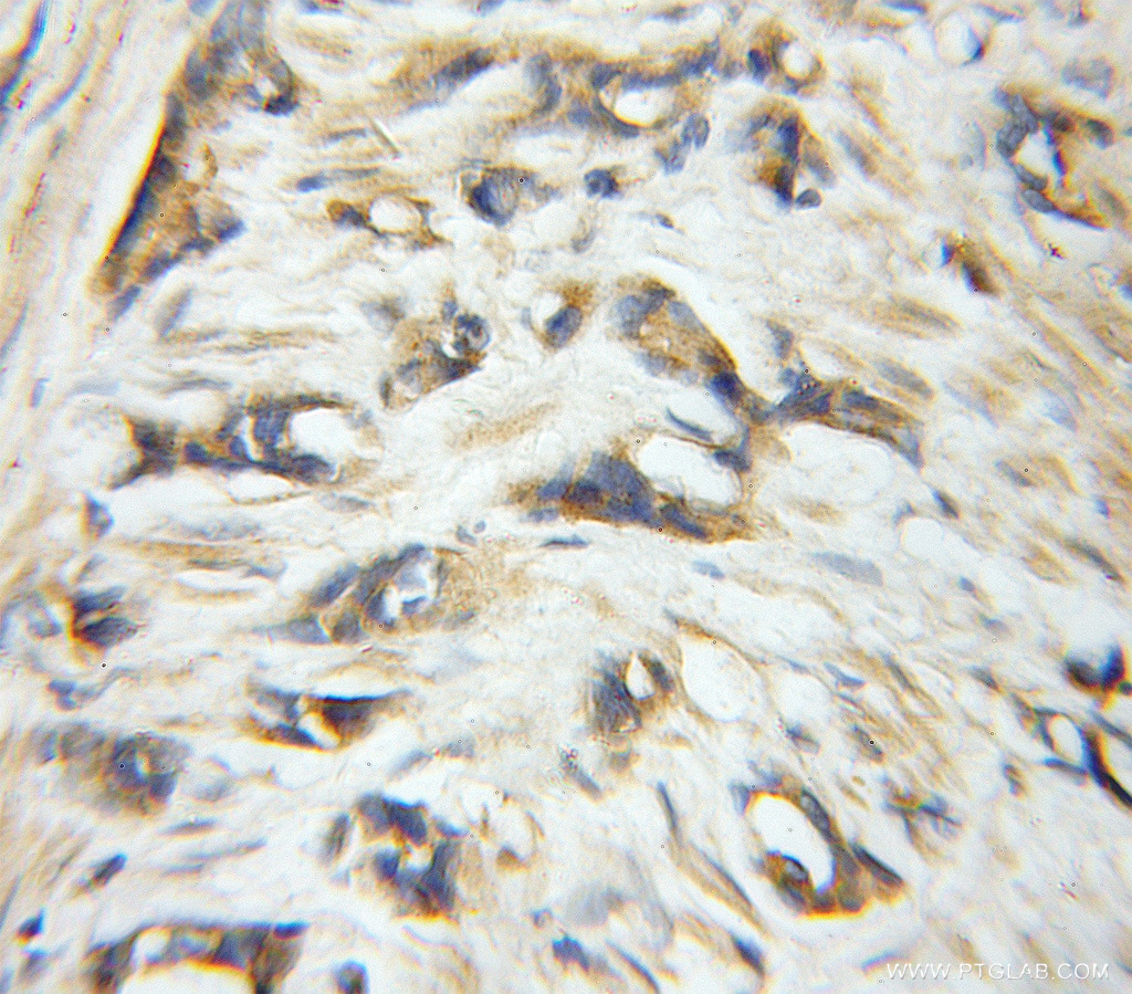 IHC staining of human prostate cancer using 10291-1-AP
