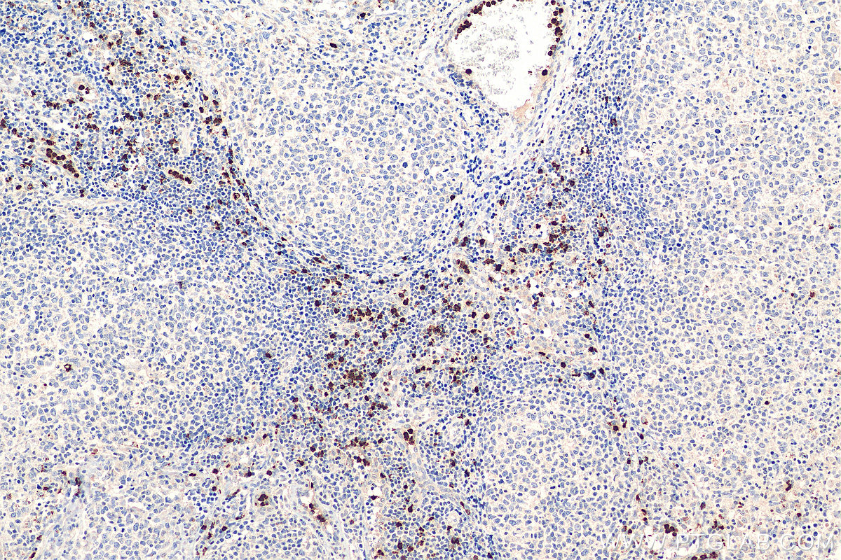 IHC staining of human lymphoma using 27642-1-AP