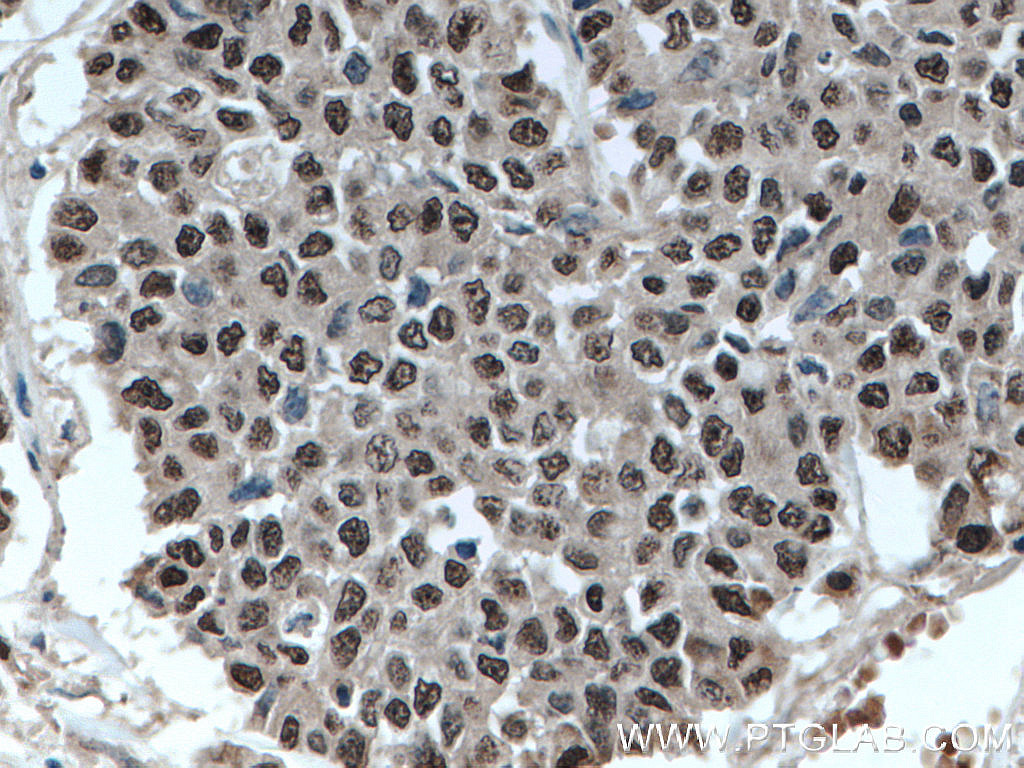 IHC staining of human colon cancer using 22565-1-AP