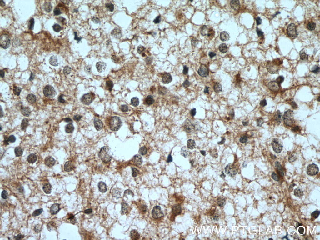 IHC staining of human gliomas using 12761-1-AP