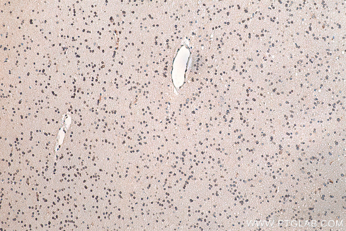 IHC staining of human gliomas using 55023-1-AP