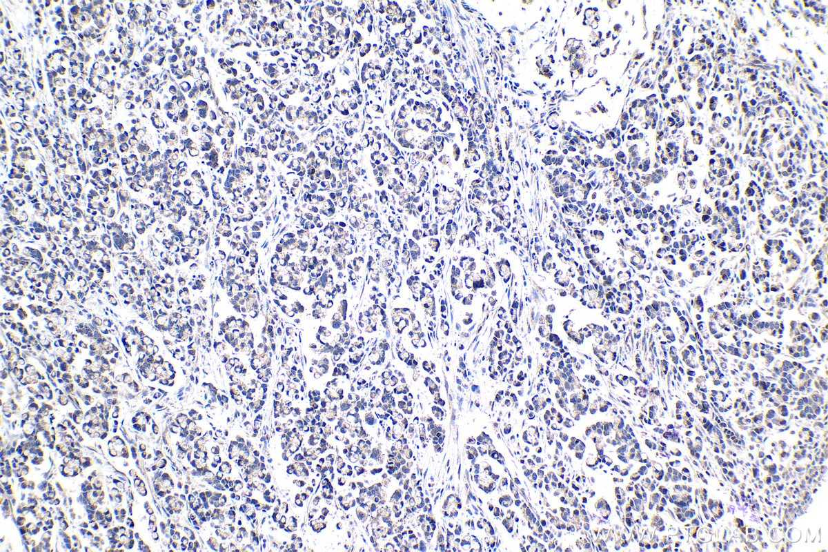 IHC staining of human colon cancer using 13793-1-AP (same clone as 13793-1-PBS)