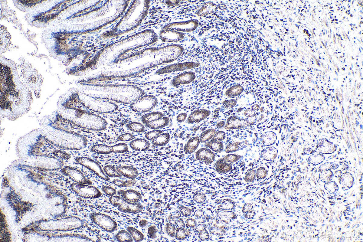 IHC staining of human stomach cancer using 13793-1-AP (same clone as 13793-1-PBS)
