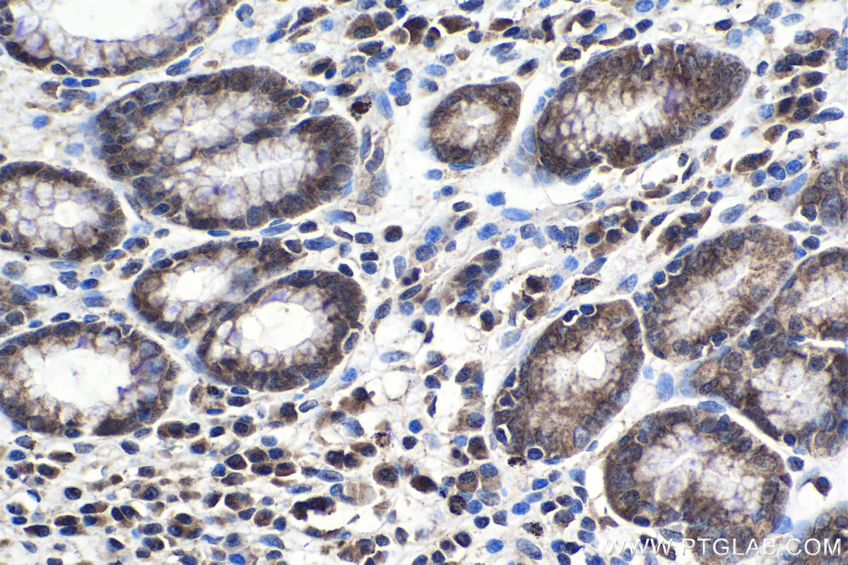 IHC staining of human stomach cancer using 13793-1-AP (same clone as 13793-1-PBS)