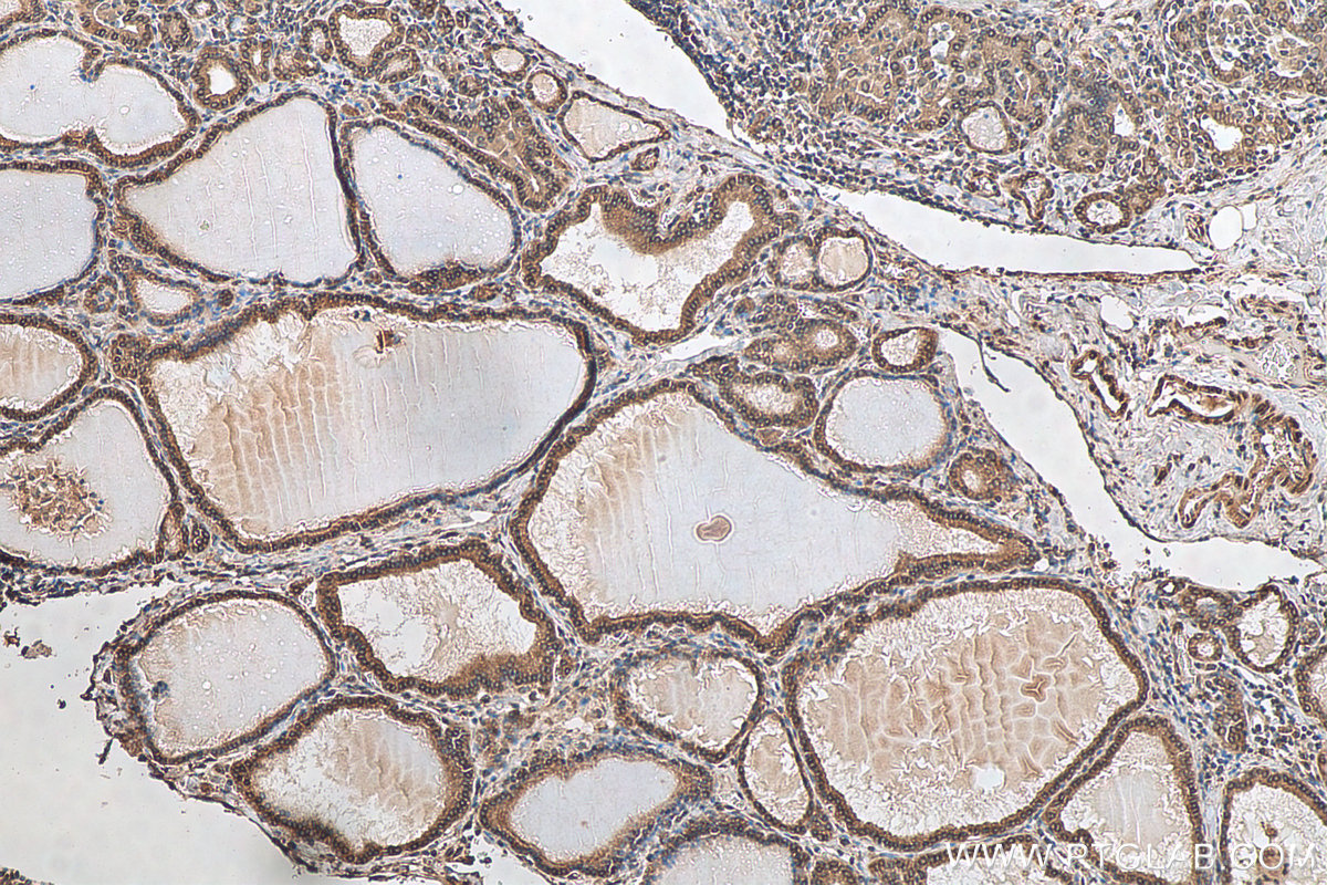 IHC staining of human thyroid cancer using 10351-1-AP