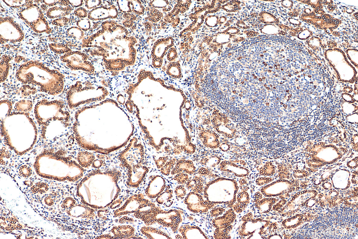 IHC staining of human thyroid cancer using 10351-1-AP