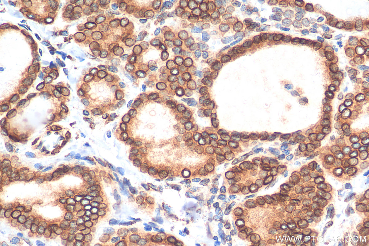 IHC staining of human thyroid cancer using 10351-1-AP