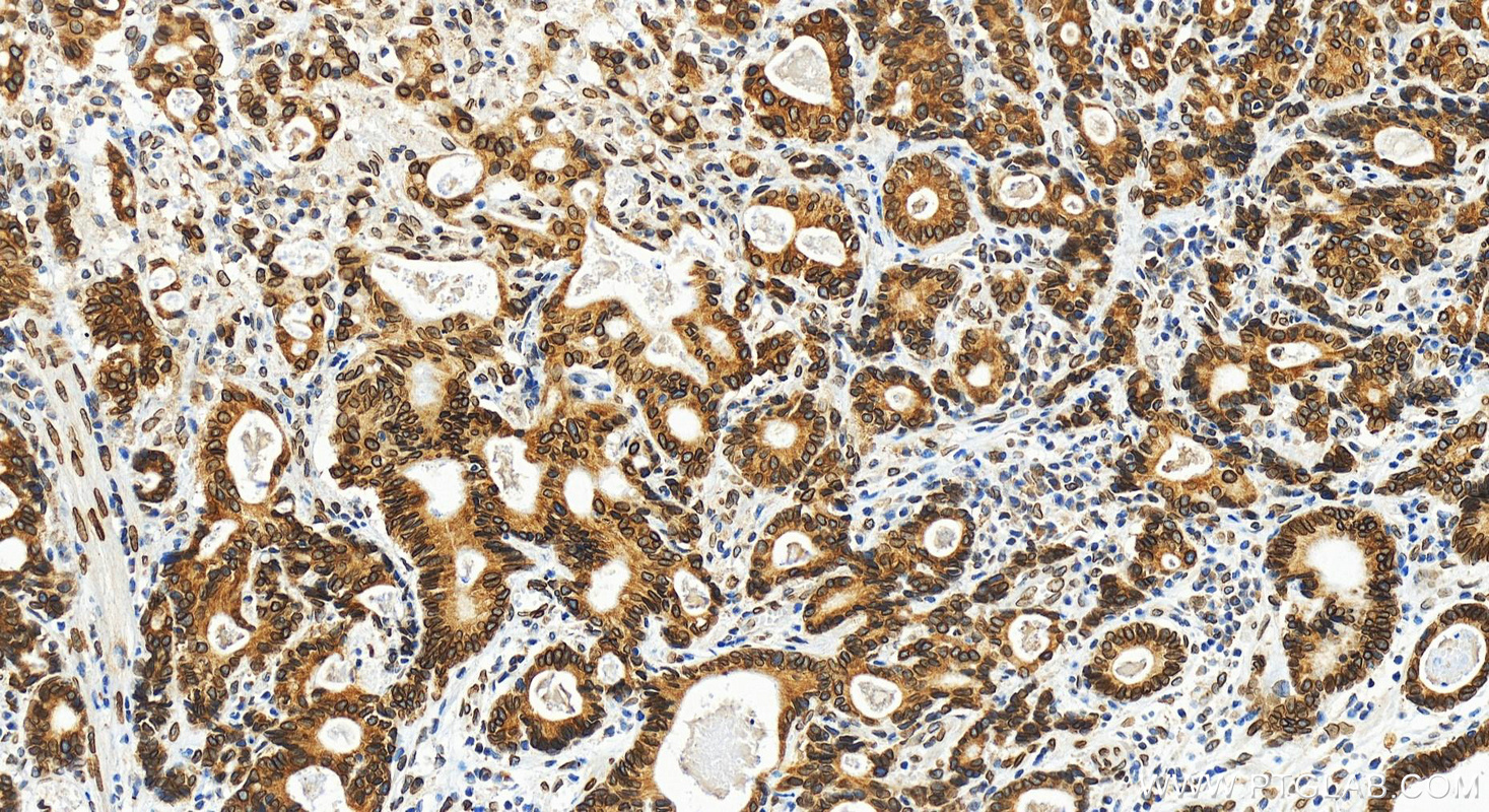IHC staining of human stomach cancer using 82888-1-RR (same clone as 82888-1-PBS)