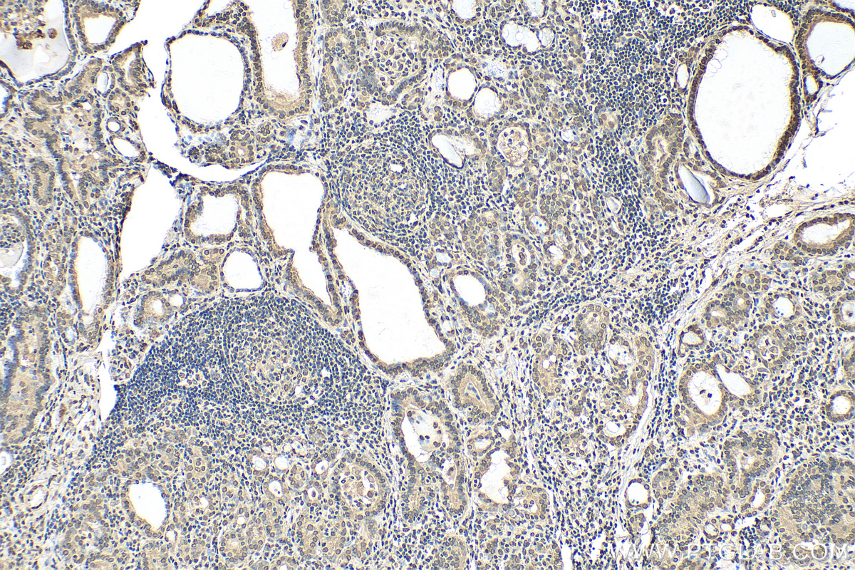IHC staining of human thyroid cancer using 82888-2-RR