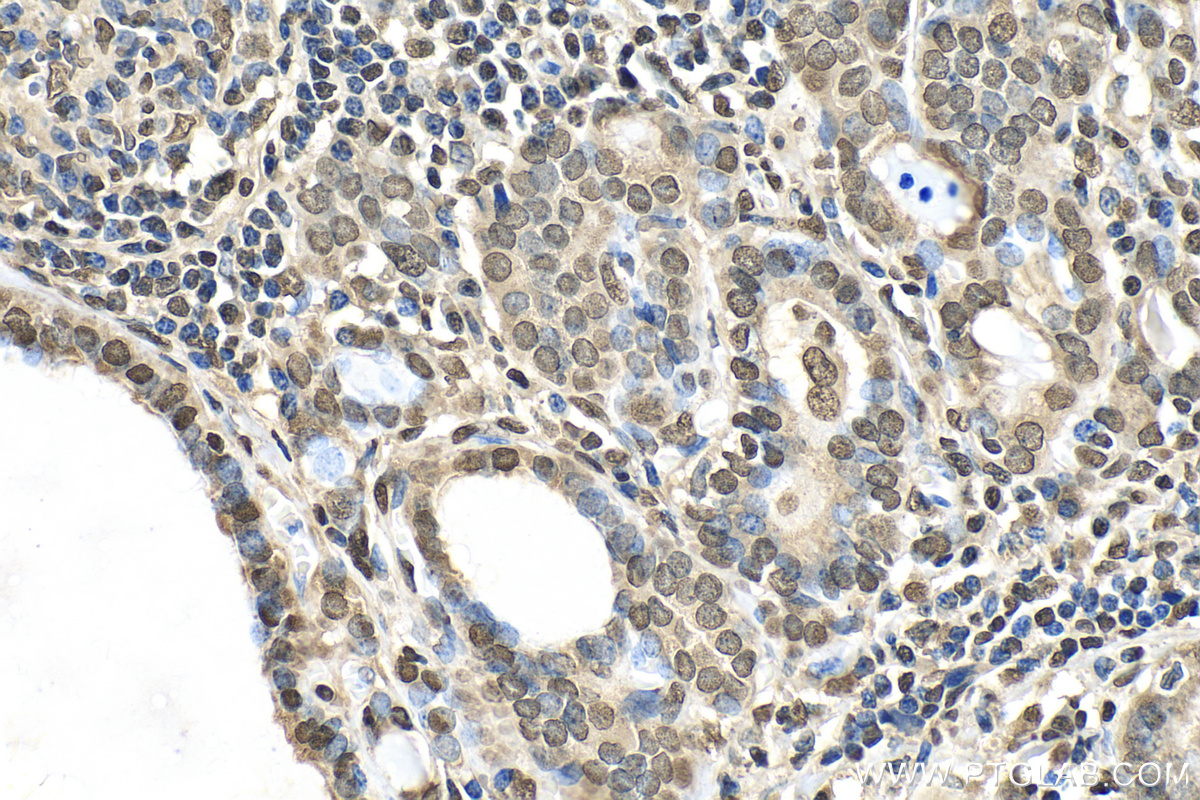 IHC staining of human thyroid cancer using 82888-2-RR